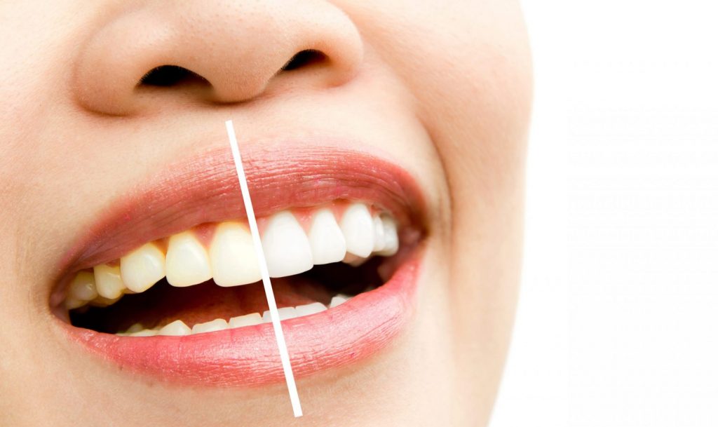 woman teeth before and after whitening. Over white background