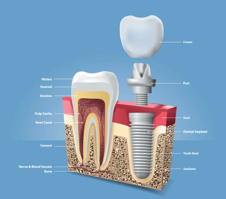 graphic explaining the parts of a dental implant